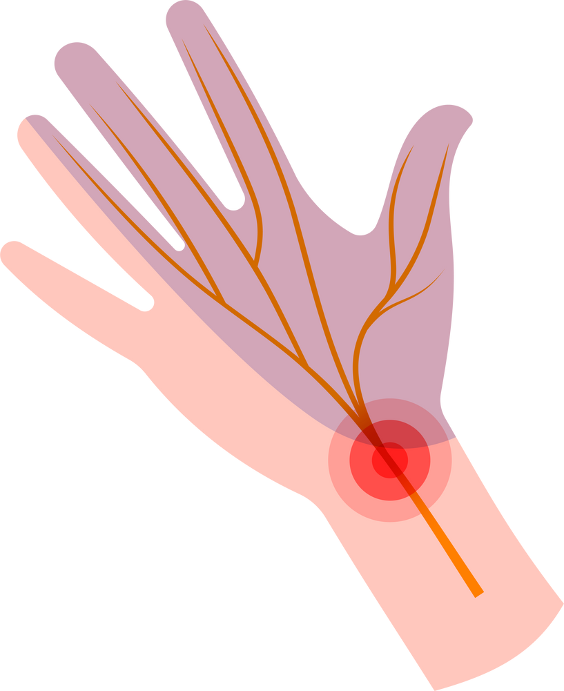 arthritis carpal tunnel syndrome cubital tenosynovitis trigger quervain pronator teres tendonitis strain injury neuropathy numbness finger hand pain arm numb tingling wrist injury nerve weakness ulnar median